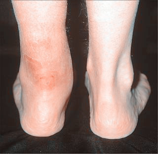 Achilles Tendinitis